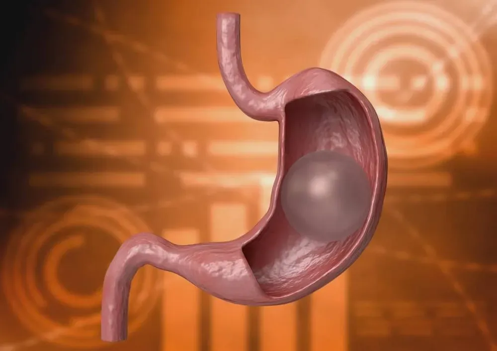 Gastric balloon Medically Proven Weight Loss Without Surgery