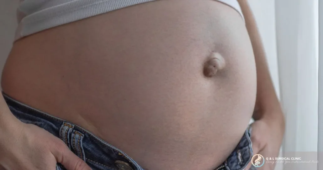 Post Partum Hernia Blog Article Image 2 1200 x 633