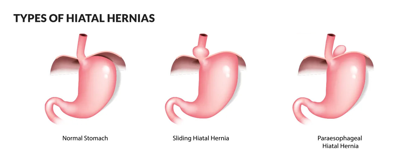 Types of Hiatal Hernia 1