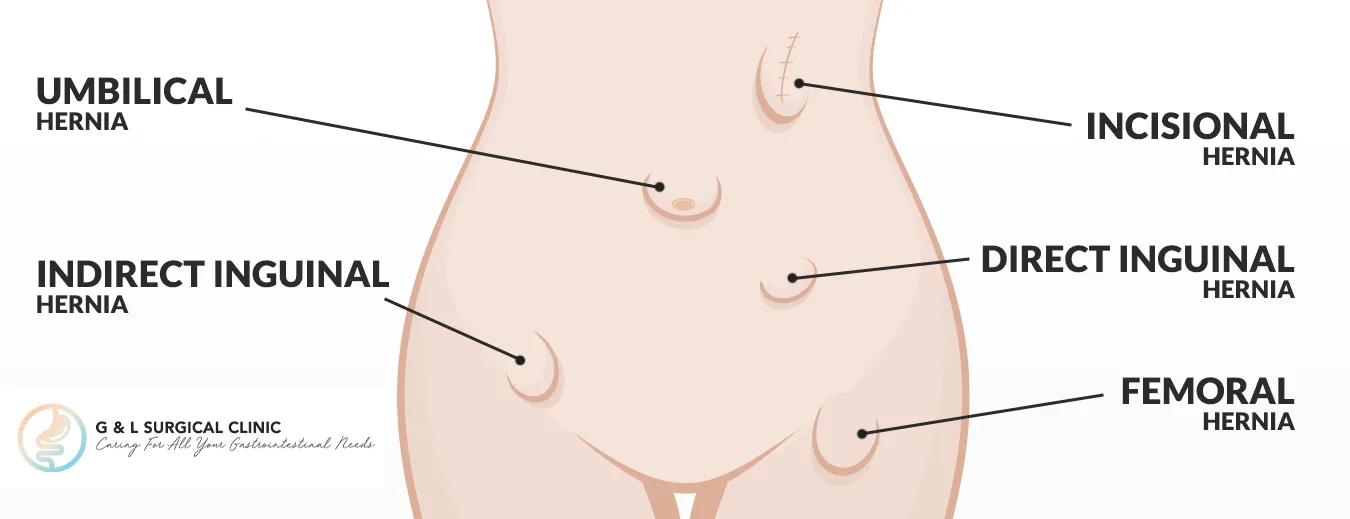 hernia conditions