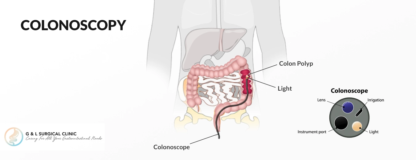 Colonoscopy 2