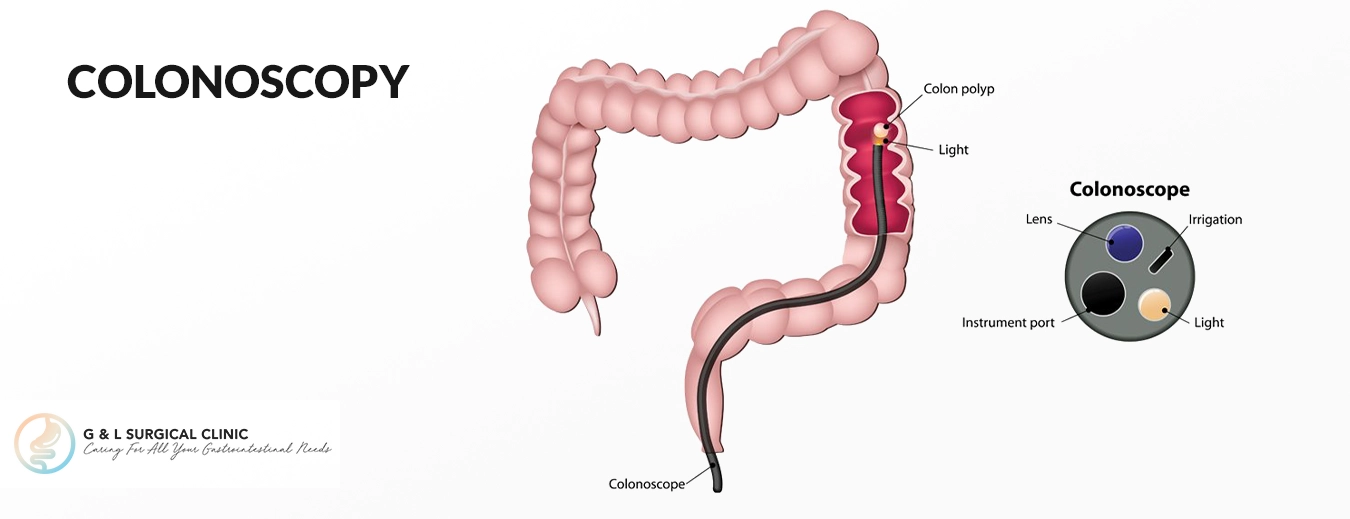 Colonoscopy