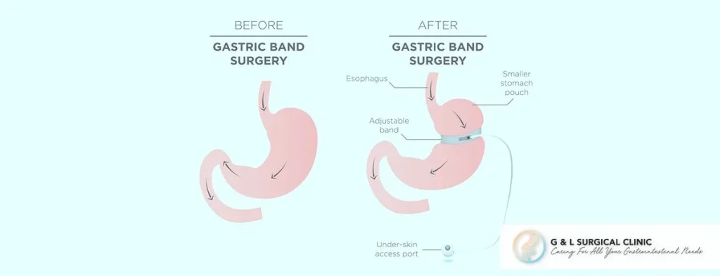 Gastric Banding 1