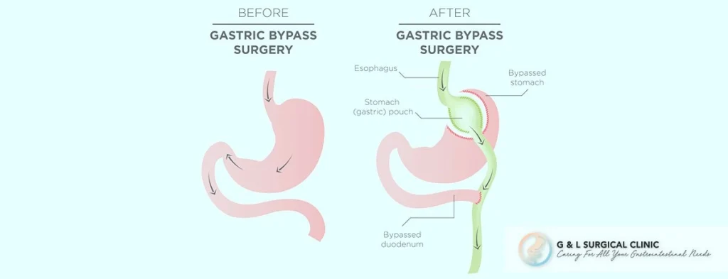 Gastric Bypass 1