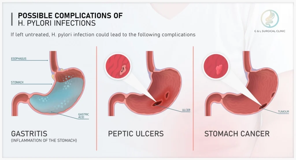 Gastric 1536x834 1