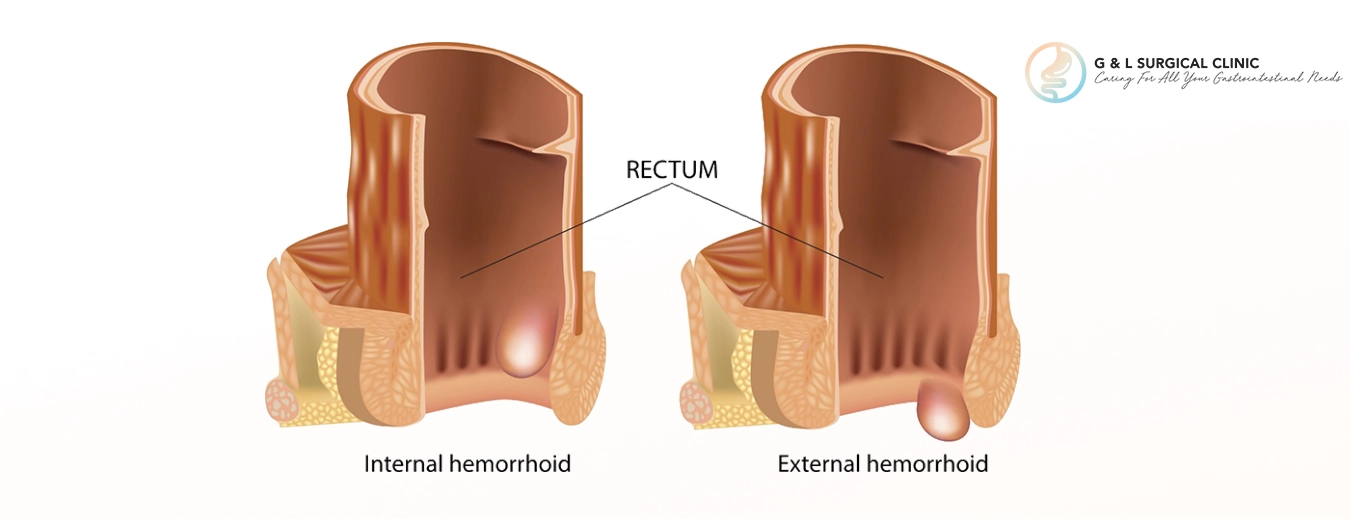 Haemorrhoids Internal External