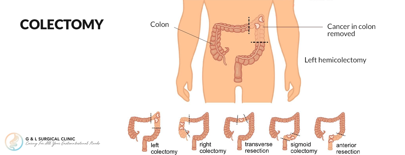 colorectal cancer procedure