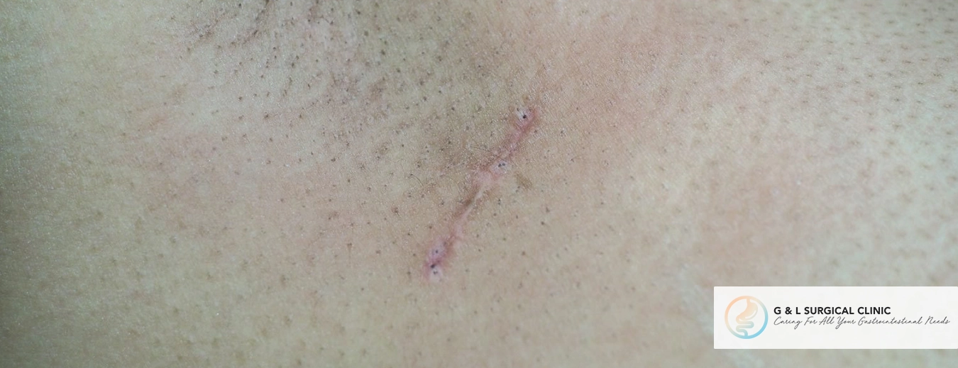 lymph glands