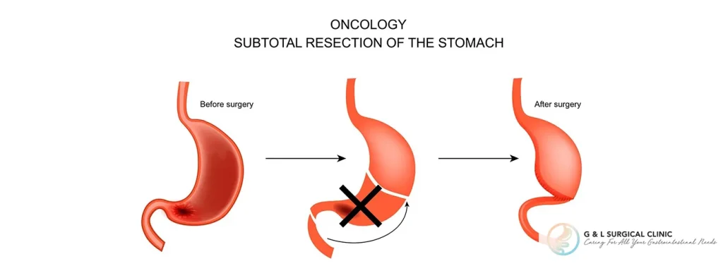 stomach cancer procedure