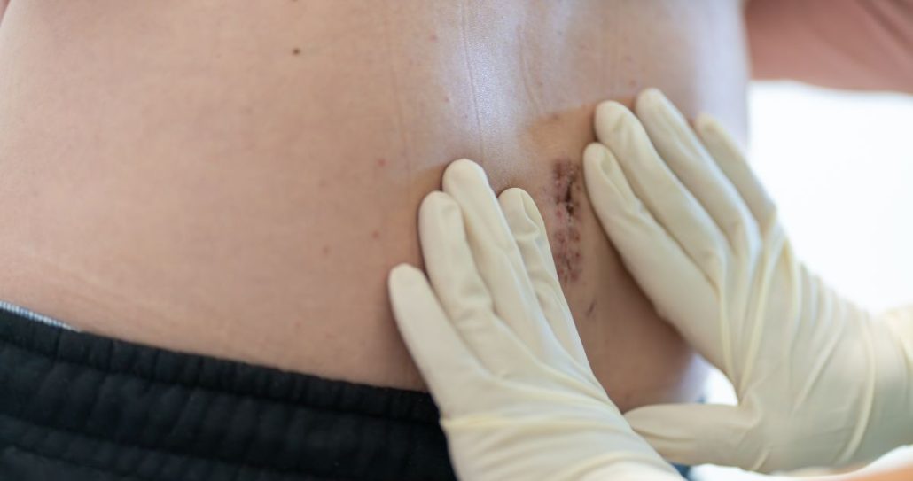 doctor checking hernia on patient